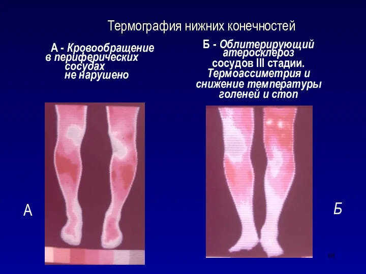 Термография нижних конечностей А - Кровообращение в периферических сосудах не