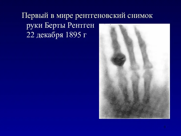 Первый в мире рентгеновский снимок руки Берты Рентген 22 декабря 1895 г