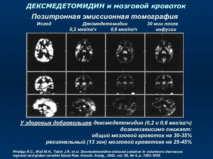 ДЕКСМЕДЕТОМИДИН и мозговой кровоток Позитронная эмиссионная томография Исход Дексмедетомидин 30 мин после 0,2