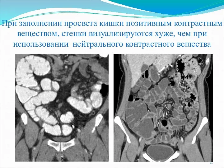 При заполнении просвета кишки позитивным контрастным веществом, стенки визуализируются хуже, чем при использовании нейтрального контрастного вещества