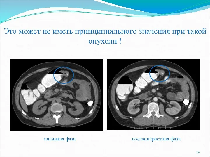 Это может не иметь принципиального значения при такой опухоли ! нативная фаза постконтрастная фаза