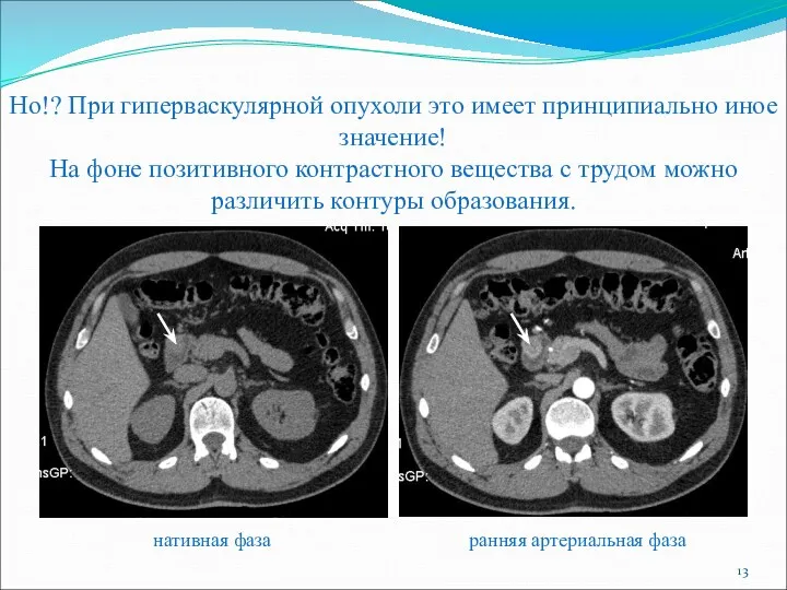 Но!? При гиперваскулярной опухоли это имеет принципиально иное значение! На