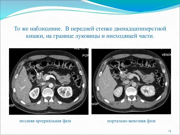 То же наблюдение. В передней стенке двенадцатиперстной кишки, на границе