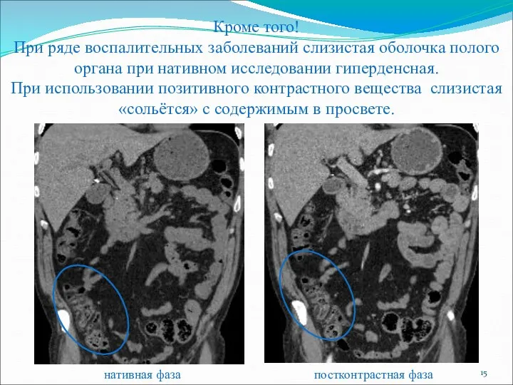 Кроме того! При ряде воспалительных заболеваний слизистая оболочка полого органа