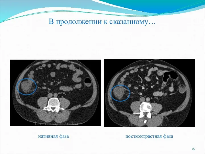 В продолжении к сказанному… нативная фаза постконтрастная фаза