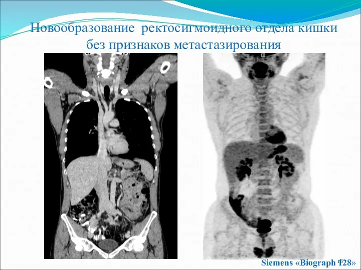 Siemens «Biograph 128» Новообразование ректосигмоидного отдела кишки без признаков метастазирования