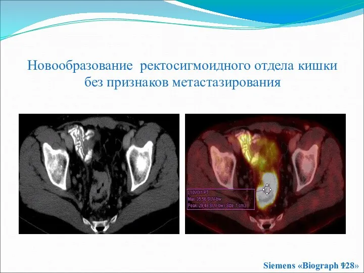 Новообразование ректосигмоидного отдела кишки без признаков метастазирования Siemens «Biograph 128»