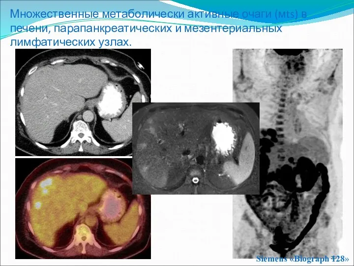 Множественные метаболически активные очаги (мts) в печени, парапанкреатических и мезентериальных лимфатических узлах. Siemens «Biograph 128»