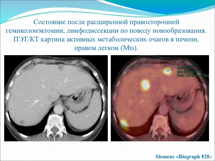Состояние после расширенной правосторонней гемиколонэктомии, лимфодиссекции по поводу новообразования. ПЭТ/КТ