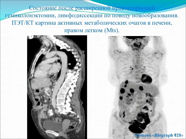 Siemens «Biograph 128» Состояние после расширенной правосторонней гемиколонэктомии, лимфодиссекции по