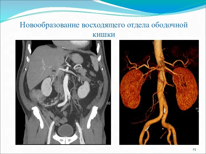 Новообразование восходящего отдела ободочной кишки