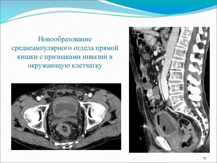 Новообразование среднеампулярного отдела прямой кишки с признаками инвазии в окружающую клетчатку