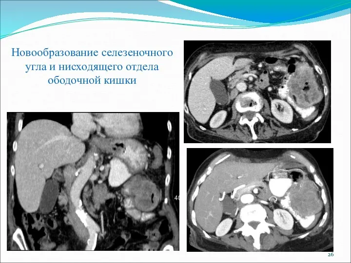 Новообразование селезеночного угла и нисходящего отдела ободочной кишки