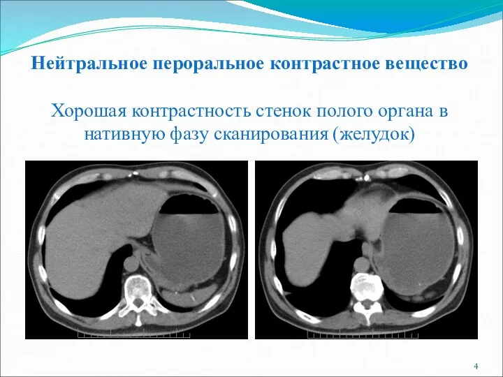 Нейтральное пероральное контрастное вещество Хорошая контрастность стенок полого органа в нативную фазу сканирования (желудок)