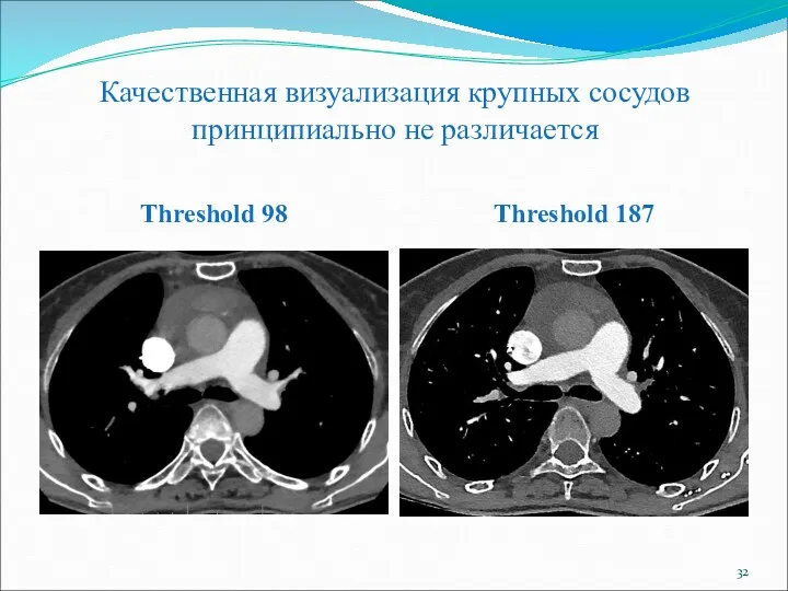 Качественная визуализация крупных сосудов принципиально не различается Threshold 98 Threshold 187