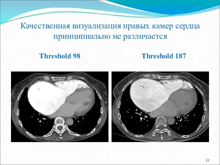 Качественная визуализация правых камер сердца принципиально не различается Threshold 98 Threshold 187