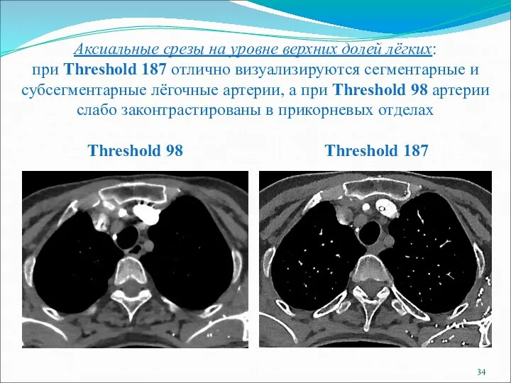 Аксиальные срезы на уровне верхних долей лёгких: при Threshold 187