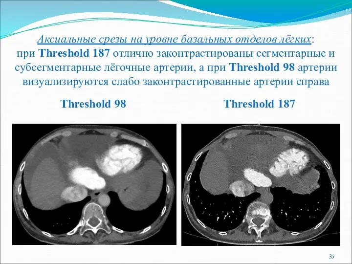 Аксиальные срезы на уровне базальных отделов лёгких: при Threshold 187