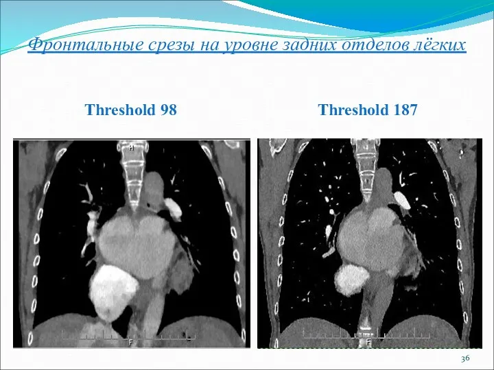 Фронтальные срезы на уровне задних отделов лёгких Threshold 98 Threshold 187