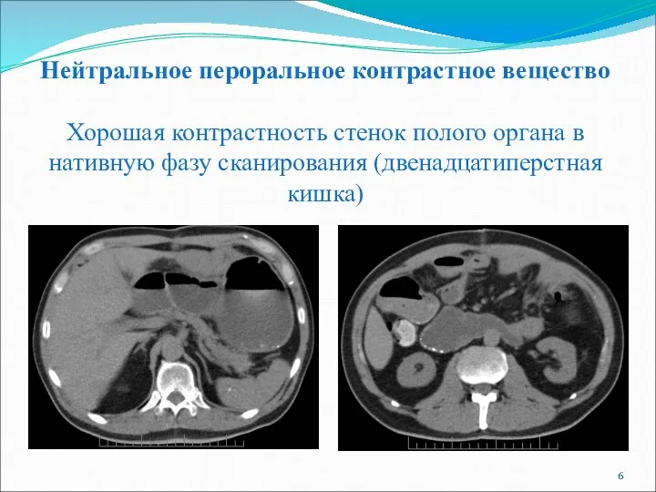 Нейтральное пероральное контрастное вещество Хорошая контрастность стенок полого органа в нативную фазу сканирования (двенадцатиперстная кишка)