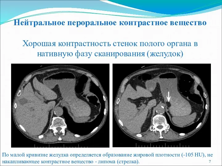 Нейтральное пероральное контрастное вещество Хорошая контрастность стенок полого органа в