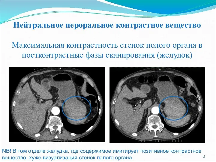 Нейтральное пероральное контрастное вещество Максимальная контрастность стенок полого органа в