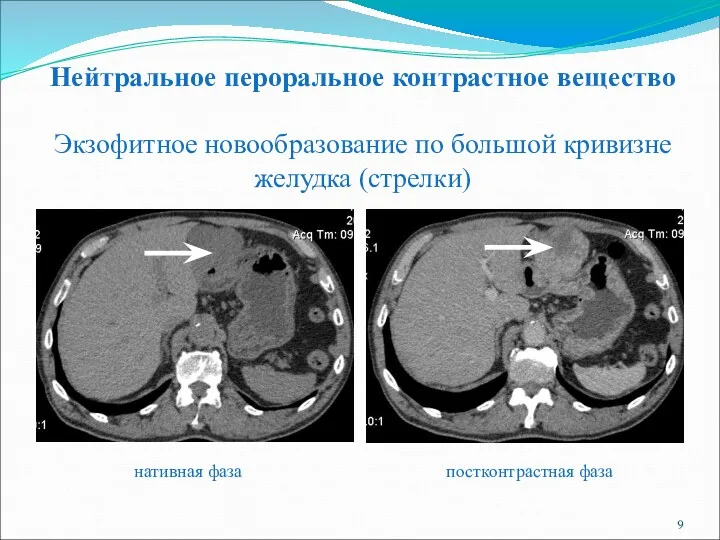 Нейтральное пероральное контрастное вещество Экзофитное новообразование по большой кривизне желудка (стрелки) нативная фаза постконтрастная фаза