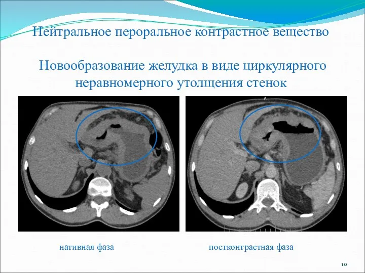 Нейтральное пероральное контрастное вещество Новообразование желудка в виде циркулярного неравномерного утолщения стенок нативная фаза постконтрастная фаза