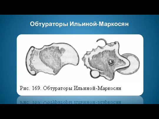 Обтураторы Ильиной-Маркосян