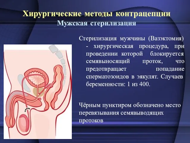 Хирургические методы контрацепции Мужская стерилизация Стерилизация мужчины (Вазэктомия) - хирургическая процедура, при проведении