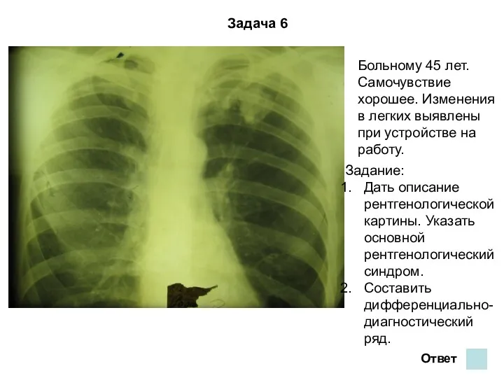 Задача 6 Больному 45 лет. Самочувствие хорошее. Изменения в легких