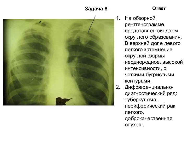 Задача 6 Ответ На обзорной рентгенограмме представлен синдром округлого образования.