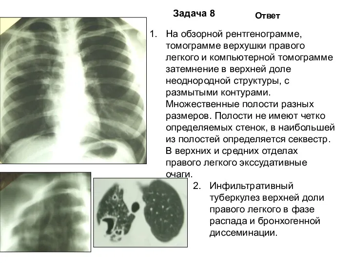 Задача 8 Ответ На обзорной рентгенограмме, томограмме верхушки правого легкого