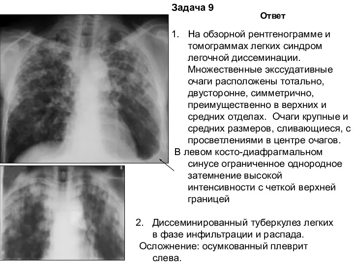 Задача 9 Ответ На обзорной рентгенограмме и томограммах легких синдром