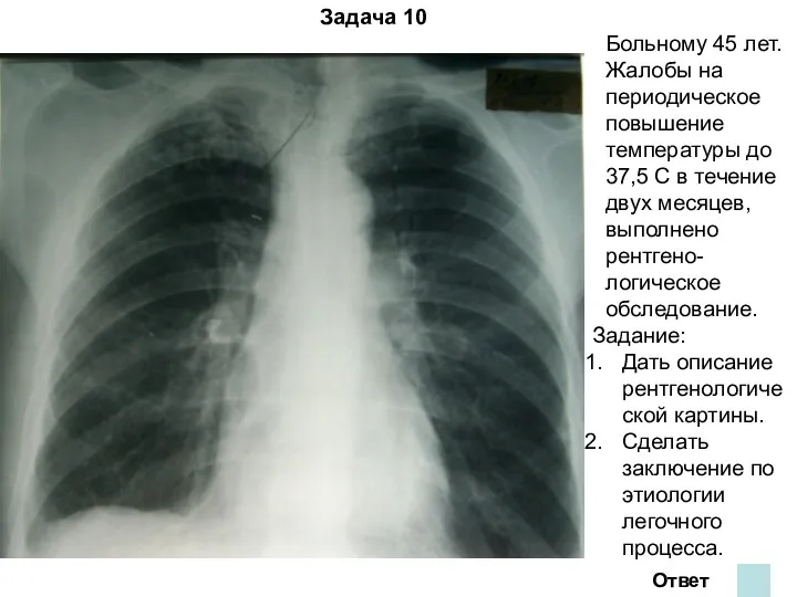 Задача 10 Больному 45 лет. Жалобы на периодическое повышение температуры