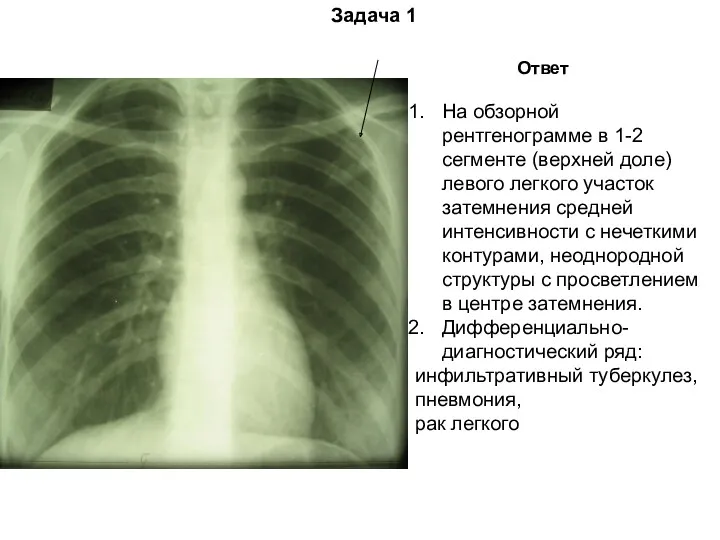 Задача 1 Ответ На обзорной рентгенограмме в 1-2 сегменте (верхней
