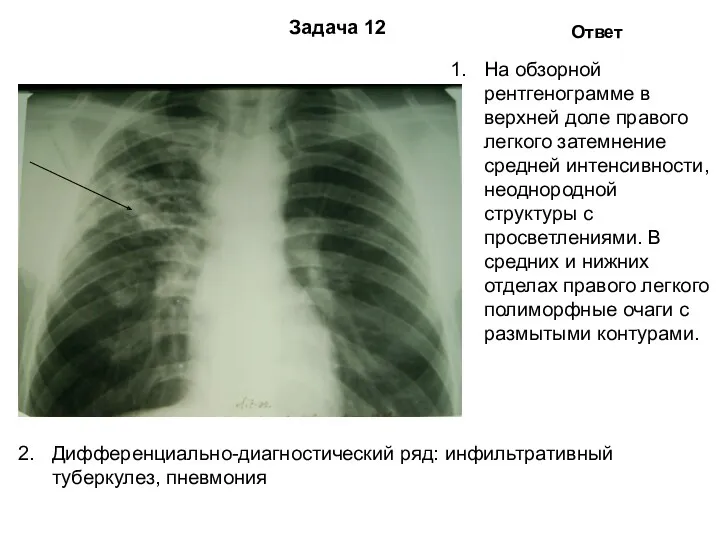 Задача 12 Ответ На обзорной рентгенограмме в верхней доле правого