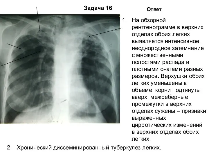 Задача 16 Ответ На обзорной рентгенограмме в верхних отделах обоих