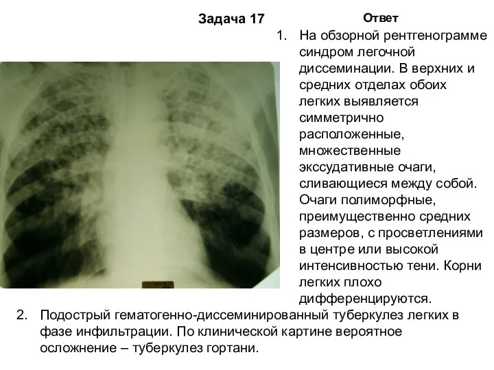 Задача 17 Ответ На обзорной рентгенограмме синдром легочной диссеминации. В