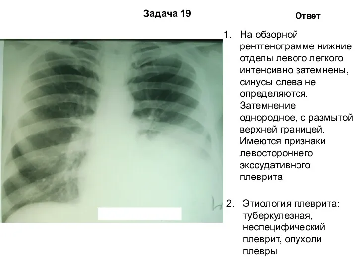 Задача 19 Ответ На обзорной рентгенограмме нижние отделы левого легкого