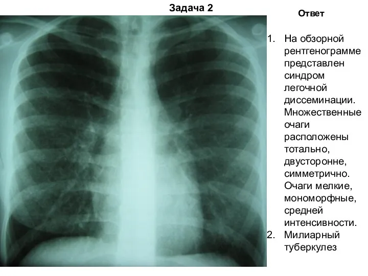 Задача 2 Ответ На обзорной рентгенограмме представлен синдром легочной диссеминации.