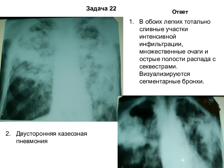 Задача 22 Ответ В обоих легких тотально сливные участки интенсивной