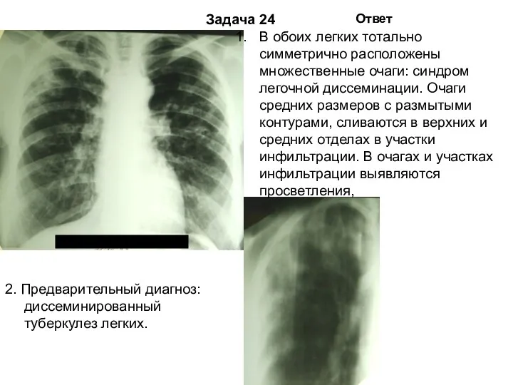 Задача 24 Ответ 2. Предварительный диагноз: диссеминированный туберкулез легких. В