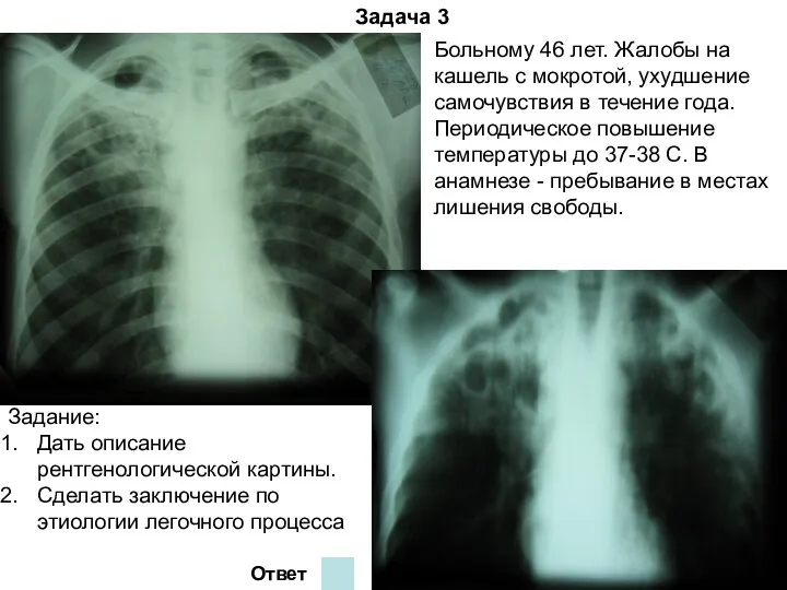 Задача 3 Больному 46 лет. Жалобы на кашель с мокротой,