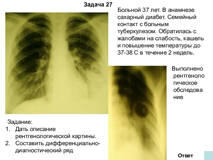 Задача 27 Ответ Больной 37 лет. В анамнезе сахарный диабет.