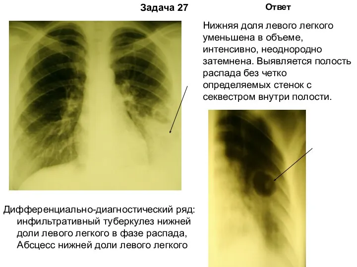 Задача 27 Ответ Дифференциально-диагностический ряд: инфильтративный туберкулез нижней доли левого