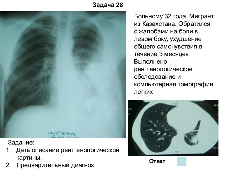 Задача 28 Ответ Больному 32 года. Мигрант из Казахстана. Обратился