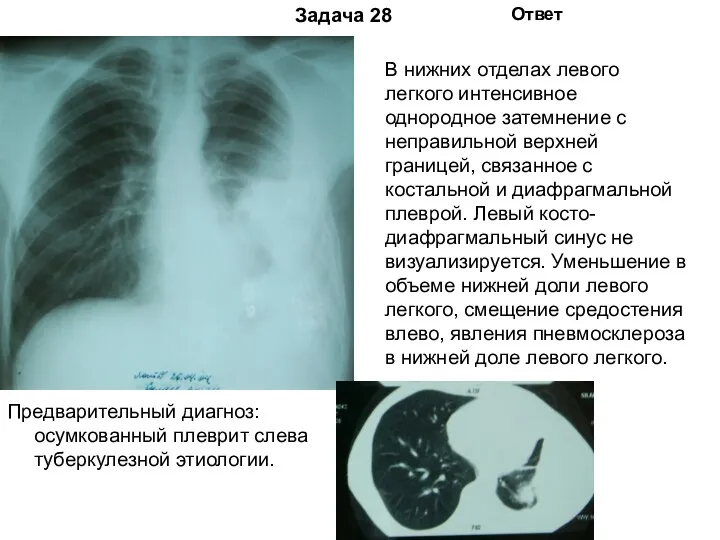 Задача 28 Ответ Предварительный диагноз: осумкованный плеврит слева туберкулезной этиологии.