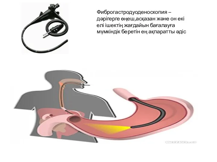Фиброгастродуоденоскопия – дәрігерге өңеш,асқазан және он екі елі ішектің жағдайын бағалауға мүмкіндік беретін ең ақпаратты әдіс