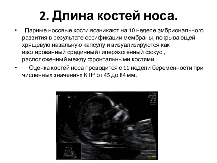 2. Длина костей носа. Парные носовые кости возникают на 10